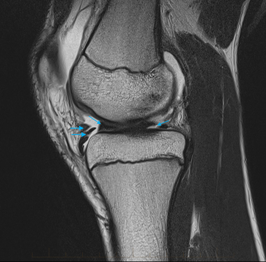 MRI knee