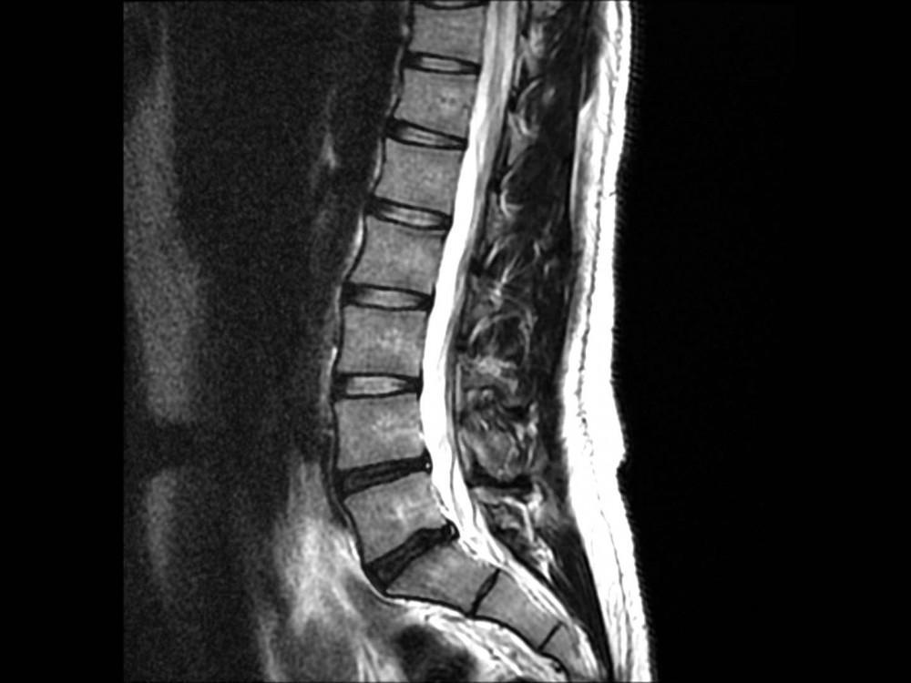 Spine MRI