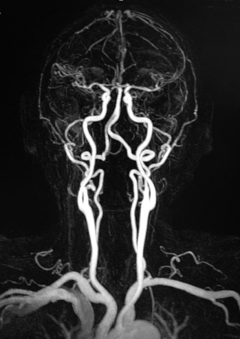 Vascular MRA