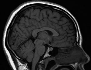 Brain MRI