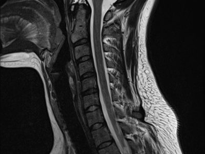 Cervical MRI