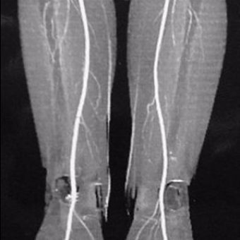 MRI Legs