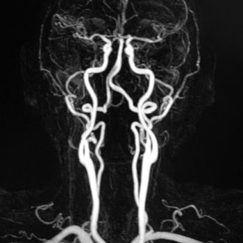 Vascular MRA